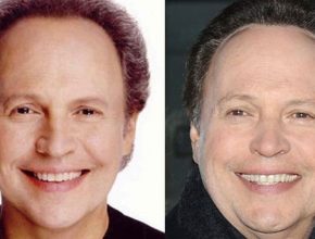 Billy Crystal before and after plastic surgery (29)