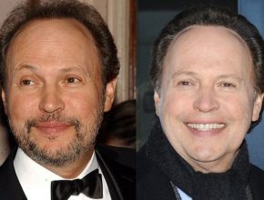 Billy Crystal before and after plastic surgery (30)