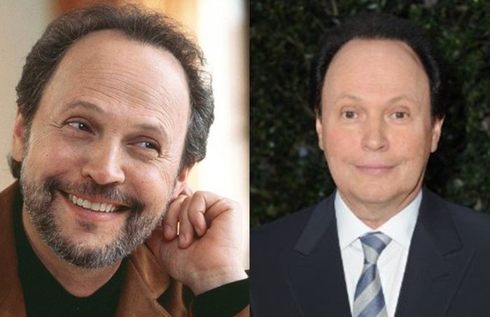 Billy Crystal before and after plastic surgery