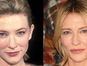 Cate Blanchett before and after plastic surgery (01)
