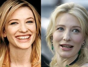 Cate Blanchett before and after plastic surgery (26)