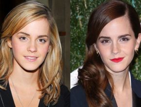 Emma Watson before and after plastic surgery (16)