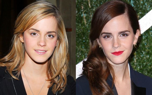 Emma Watson before and after plastic surgery (16) .