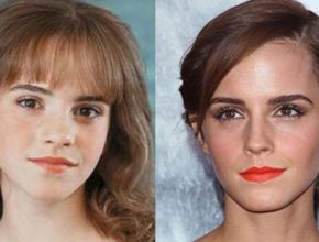 Emma Watson before and after plastic surgery (17)