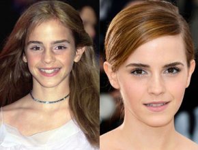 Emma Watson before and after plastic surgery
