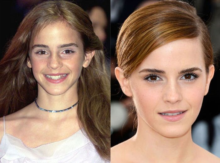 Emma Watson before and after plastic surgery