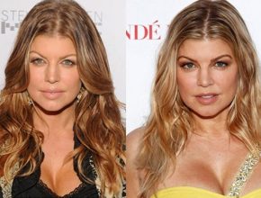 Fergie before and after plastic surgery (20)