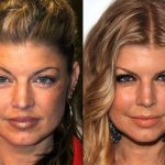 Fergie before and after plastic surgery (22)
