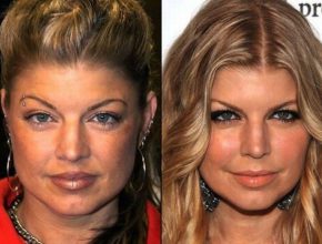 Fergie before and after plastic surgery (22)