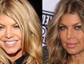 Fergie before and after plastic surgery (6)