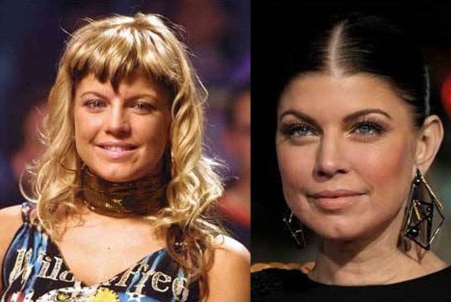 Fergie before and after plastic surgery