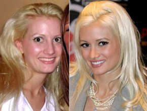 Holly Madison before and after plastic surgery