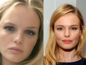 Kate Bosworth before and afte rplastic surgery