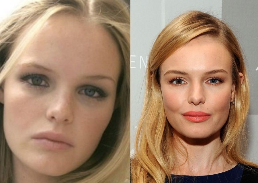 Kate Bosworth before and afte rplastic surgery