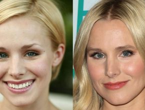 Kristen Bell before and after plastic surgery