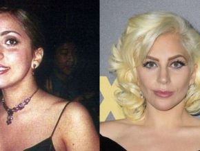 Lady Gaga before and after plastic surgery (21)
