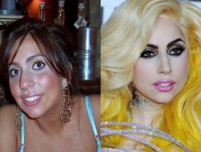 Lady Gaga before and after plastic surgery