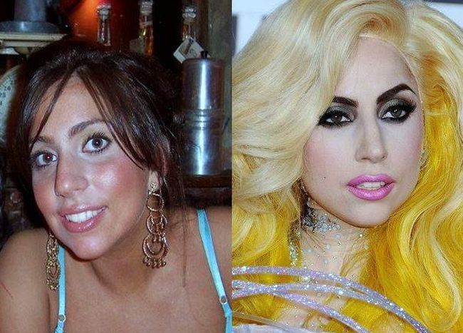 Lady Gaga before and after plastic surgery.