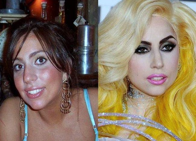 Lady Gaga before and after plastic surgery