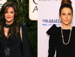 Lisa Marie Presley before and after plastic surgery