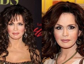 Marie Osmond before and after plastic surgery