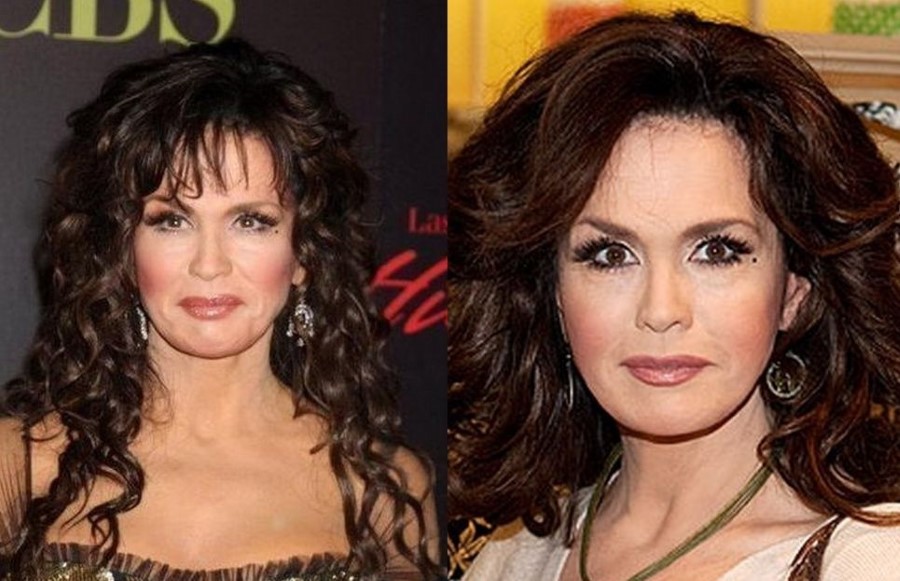 Marie Osmond before and after plastic surgery