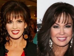 Marie Osmond before and after plastic surgery (15)