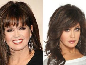 Marie Osmond before and after plastic surgery