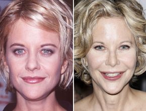 Meg Ryan before and after plastic surgery