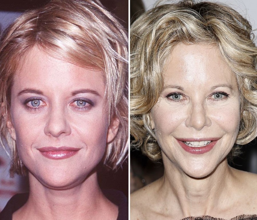 Meg Ryan before and after plastic surgery