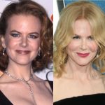 Nicole Kidman before and after plastic surgery (18)