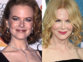 Nicole Kidman before and after plastic surgery (18)