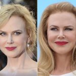 Nicole Kidman before and after plastic surgery (21)