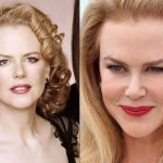 Nicole Kidman before and after plastic surgery (28)