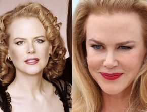 Nicole Kidman before and after plastic surgery (28)