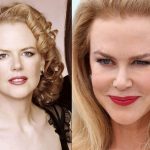 Nicole Kidman plastic surgery (26)