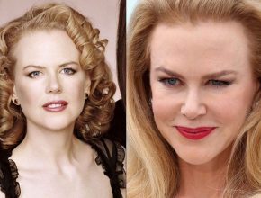 Nicole Kidman plastic surgery (26)