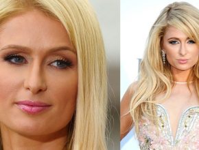 Paris Hilton before and after plastic surgery (13)