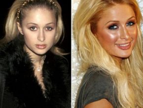Paris Hilton before and after plastic surgery