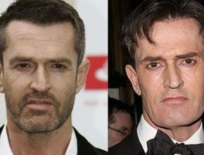 Rupert Everett before and after plastic surgery