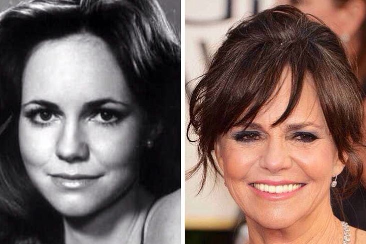 Sally Field before and after plastic surgery