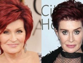 Sharon Osbourne before and after plastic surgery (1)