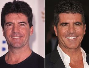 Simon Cowell before and after plastic surgery (26)