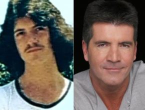 Simon Cowell before and after plastic surgery