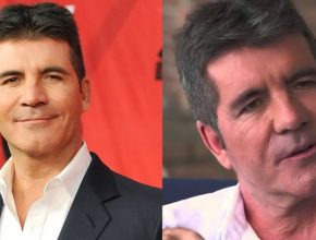 Simon Cowell before and after plastic surgery (38)