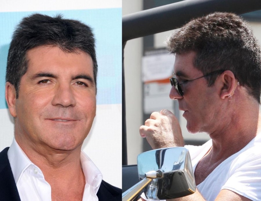 Simon Cowell plastic surgery (32) Celebrity plastic surgery online