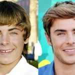 Zac Efron before and after plastic surgery (19)