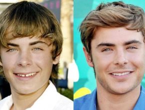Zac Efron before and after plastic surgery (19)