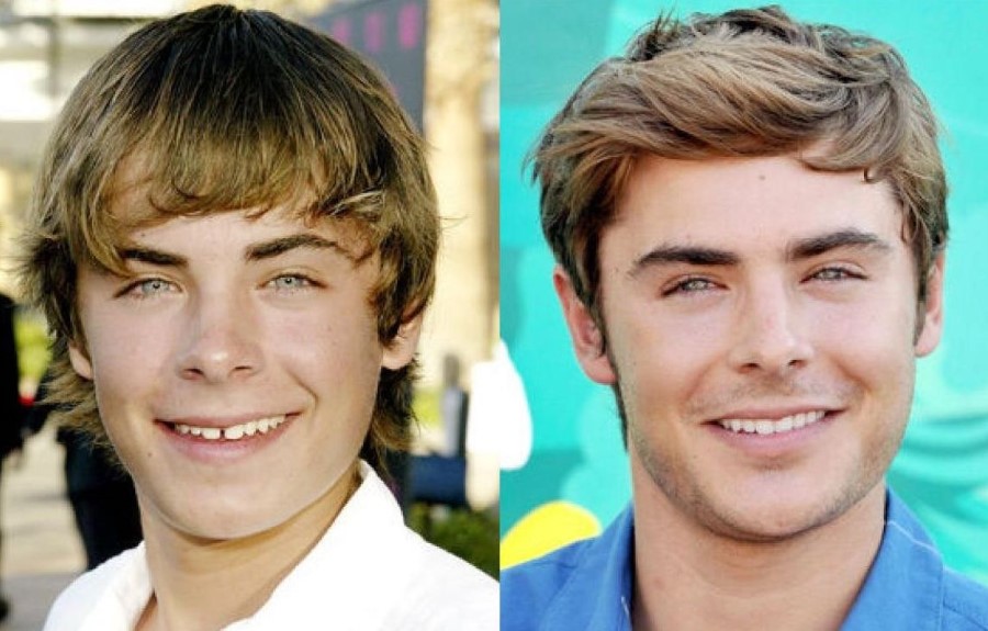Zac Efron Before And After Plastic Surgery 19 Celebrity Plastic Surgery Online