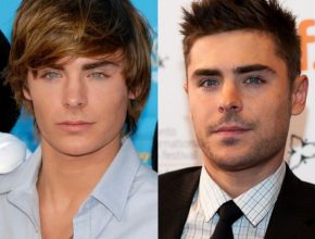 Zac Efron before and after plastic surgery